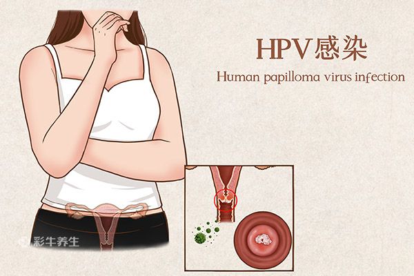 hpv是什么病 hpv的症状有哪些