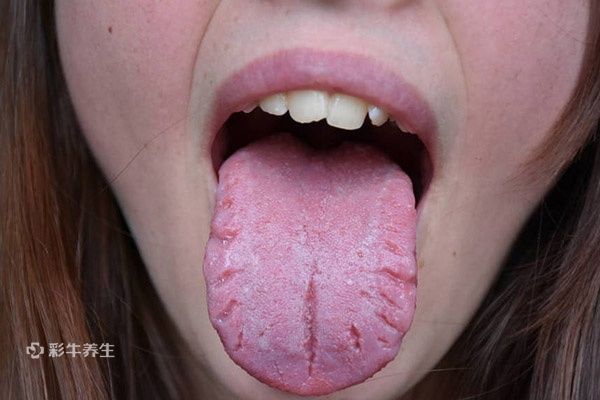 舌头有裂纹是怎么回事