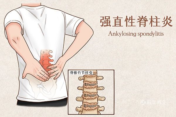 后背疼的原因 5个疾病会引起后背疼