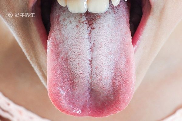舌头有裂纹是怎么回事