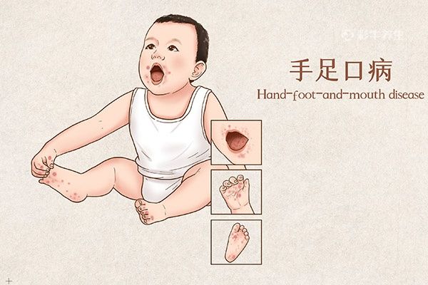 手足口病症状图片 手足口病的初期症状