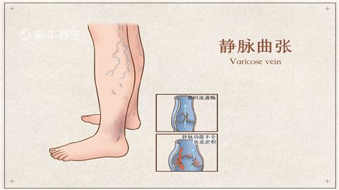 静脉血栓形成治疗方法有哪些