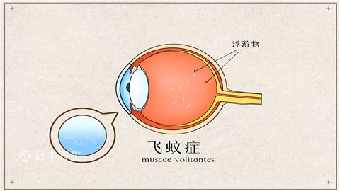 阴影像蚊子一样;所以,出现飞蚊症的患者,可选择滴氨碘肽滴眼液,狄奥宁