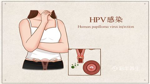 hpv52阳性是高危型的人乳头状瘤病毒,常见于身体免疫力低下,或者是