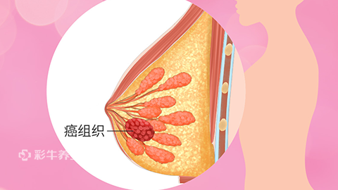 乳腺癌.png