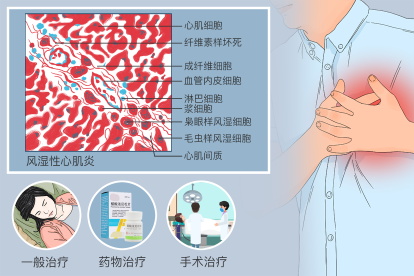 风湿性心肌炎病理切片画图