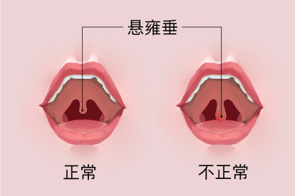 悬雍垂正常图片和不正常图片