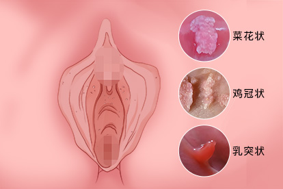 尖锐湿疣典型图片
