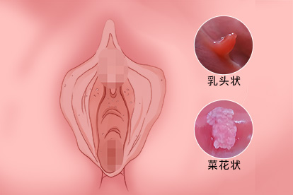 女性hpv症状图片