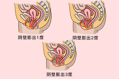 阴壁膨出1度2度3度图片