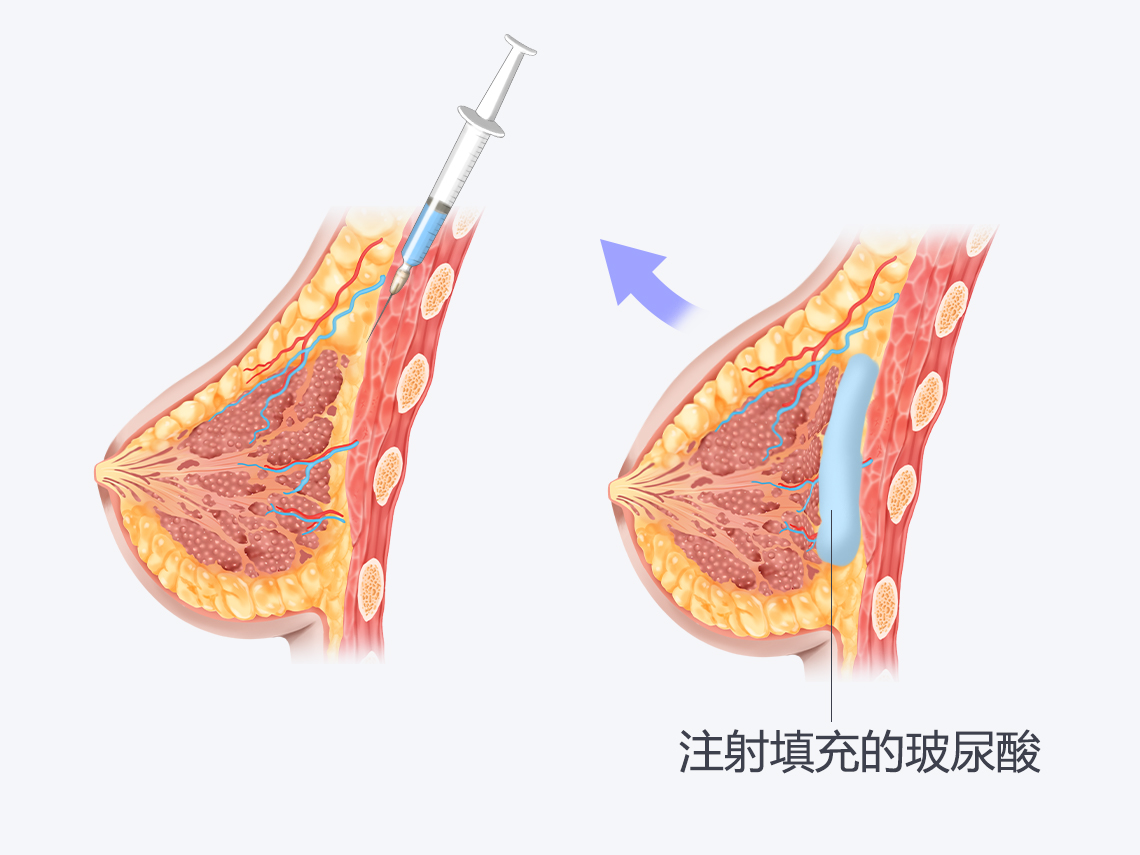 哺乳后胸部干瘪下垂还能恢复吗}