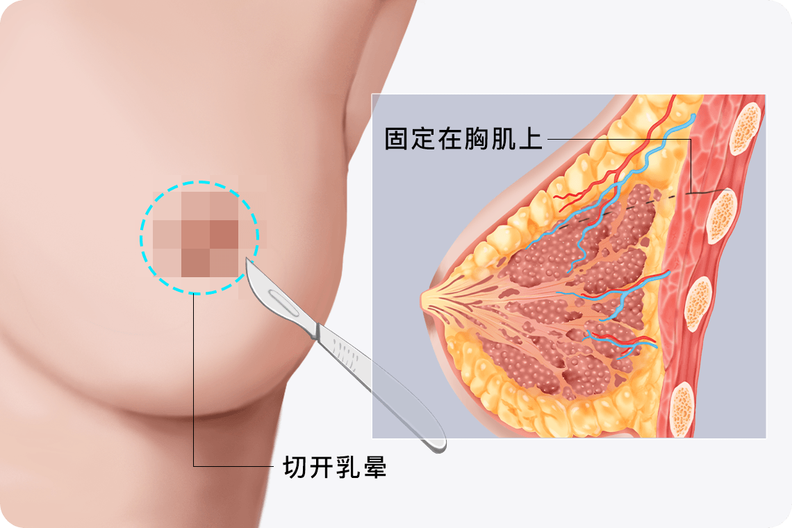 乳房懸吊術(shù)風(fēng)險(xiǎn)大嗎