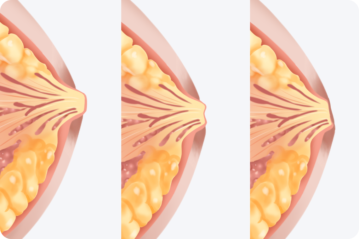 乳頭內陷矯正器有用嗎