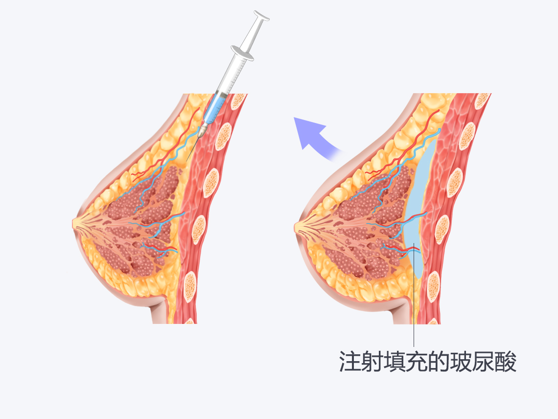 不穿内衣胸会下垂吗}