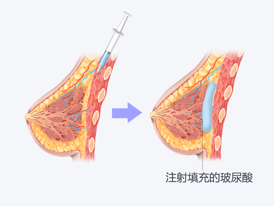 乳房软软的没有弹性怎么办