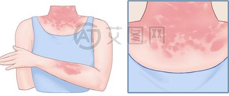 晒斑红肿症状图片