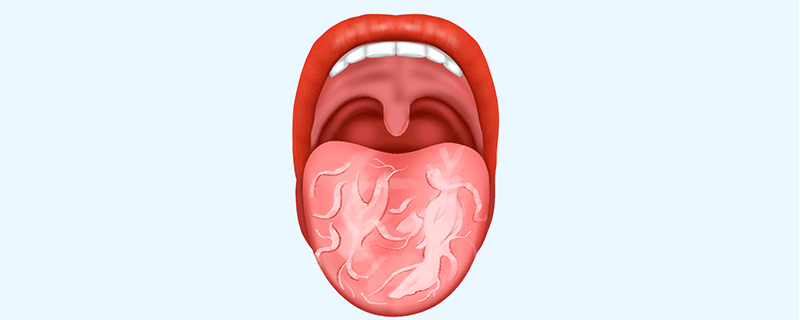 地圖舌腸癌的前兆