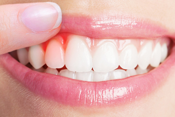 刷牙牙齿出血怎么回事 刷牙牙龈、牙齿出血的具体原因-养生法典