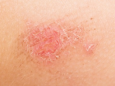 挤痘后留下黑疤怎么办 去除黑疤的有效措施
