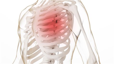 2,肋软骨炎 又称前胸壁综合征,此类疾病一般与外伤有关,当患者在搬运
