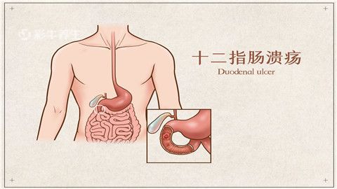 十二指肠炎的症状表现图片