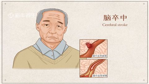 偏癱的治療方法