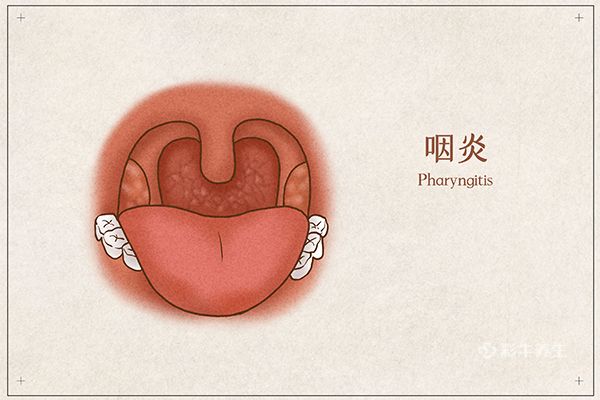 咽炎怎麼治好的最快 治療咽喉炎方法