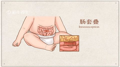 宝宝肠套叠症状