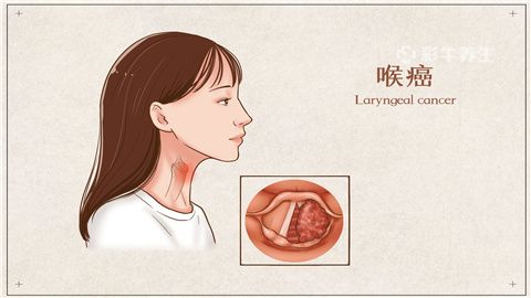 咽癌早期的五大症状图片
