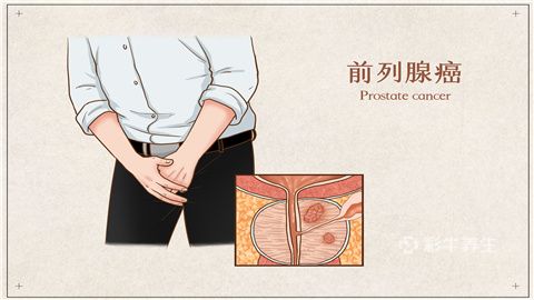 前列腺癌早期症状图片