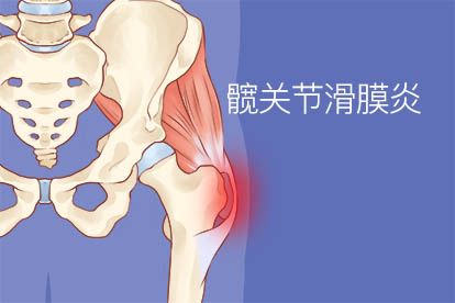 髖關節滑膜炎牽引