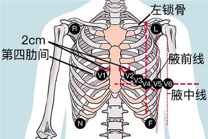 holter电极粘贴位置图图片