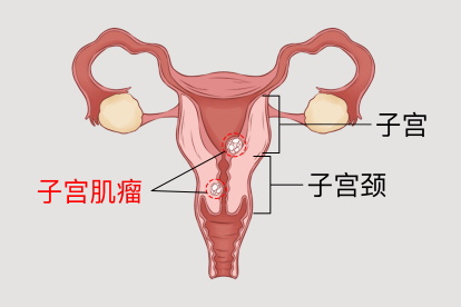 子宫肌瘤位置图