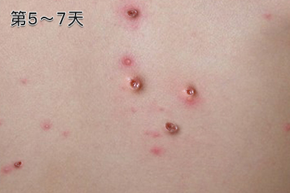 1,第1～2天:水痘大多数刚开始时症状并不明显,有的会有低热,烦躁,头痛