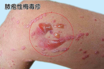 梅毒脓包症状的照片图片