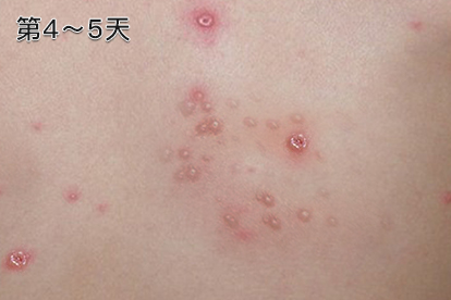 大人感染水痘变化图片图片