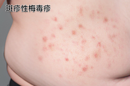 梅毒疹是感染梅毒后所表现出的二期梅毒临床症状之一,可分为斑疹性