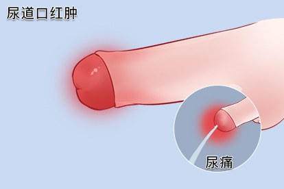 男性淋病症状有尿道口红肿