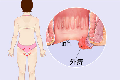 外痔早期症状图片