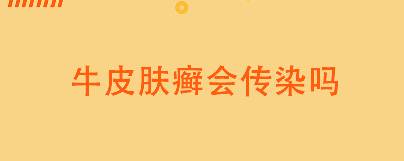 牛皮癬會(huì)傳染嗎