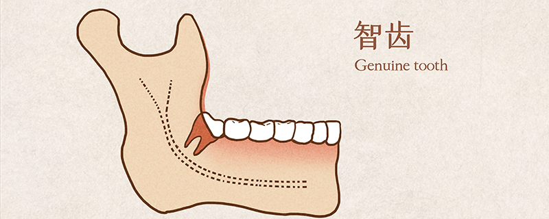 长了智齿一定要拔吗