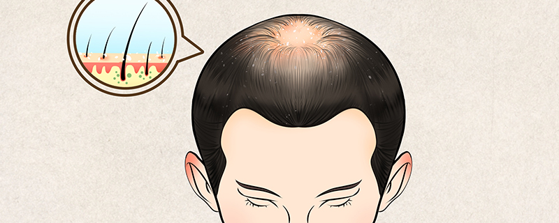 如何治疗头顶头发稀少