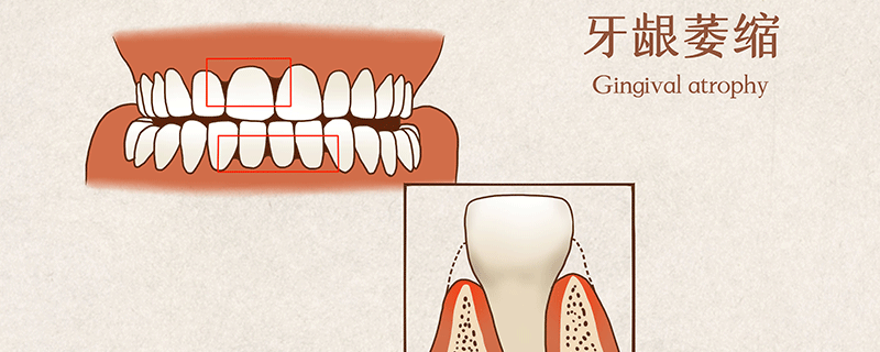 牙龈委缩有办法可以治吗
